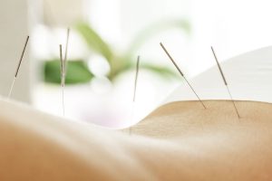 Acupuncture patient