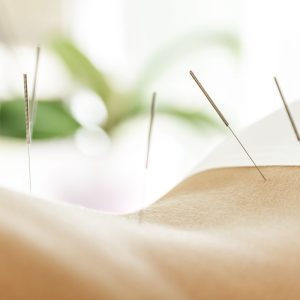 Acupuncture patient